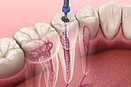 Why Choose a Crown After Root Canal Treatment?