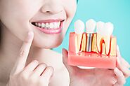 Find Dental Implants Near Me in Chandigarh - Esthetica Dental