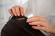 Dandruff Treatment at Home: Effective Remedies for Flake-Free Hair