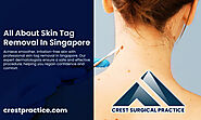 Smooth Skin Awaits: Skin Tag Removal in Singapore