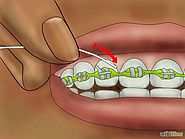 How to Floss With Braces