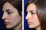 What Can Rhinoplasty Do For You?