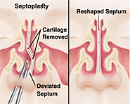 Septoplasty in Dubai | Dr. Mustafa Kapadia