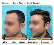 Hair Transplant in Dehi by Jangid