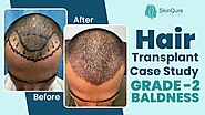 Hair Transplant Case Study Grade 2 Baldness | Dr. Jangid | Best Hair Transplant Doctor Delhi