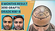 Best Hair Transplant Results - Dr Jangid