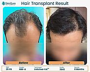 FUE Hair Transplant Clinic Delhi