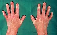 Scleroderma: a disease of the connective tissue
