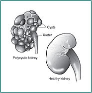 Polycystic Kidney disease: an inherited issue