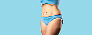 Can A Tummy Tuck Eliminate My Stretch Marks?