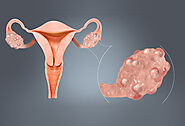 How is polycystic ovary syndrome (PCOS) treated?