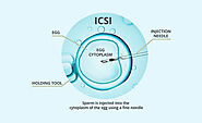 What is ICSI treatment?