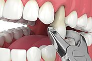 Signs You May Need to Have a Tooth Pulled | Everbright Smiles