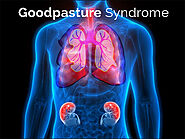 Healing Goodpasture Syndrome Naturally with Ayurvedic Remedies