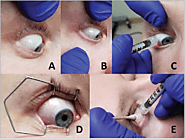 Patient Pain During Intravitreal Injections Under Topical Anesthesia