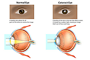 Is Cataracts and Glaucoma the Same?