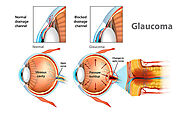 What Is Usually the First Sign of Glaucoma?