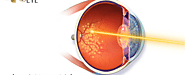 Laser Treatment for Diabetic Retinopathy: What to Expect?