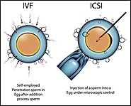 Intracytoplasmic Sperm Injection (ICSI) in In Vitro Fertilization (IVF): A Comprehensive Guide