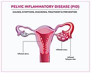 Pelvic Inflammatory Disease (PID): Causes, Symptoms,Diagnosis, Treatment & Prevention