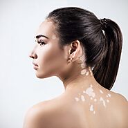 Vitiligo Treatment In Ahmedabad At Lowest Price With Assure Cosmetic Studio