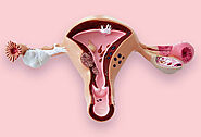 Role of Pelvic Infection in Infertility