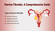 Uterine Fibroids: Causes, Symptoms, Types and Treatment