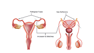 Understanding Sterilization Procedures: Tubectomy and Vasectomy - Gaudium IVF