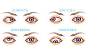 Squint Eye Surgery - Dr. Anisha Gupta - Excel Eye