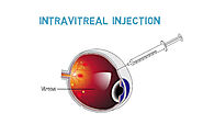 What is Retinopathy of Prematurity?