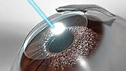 How Safe Is Cataract Surgery?