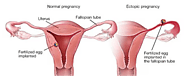 How to Avoid Ectopic Pregnancy with IVF