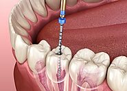 Dental implant treatment in indore