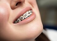 Best Teeth Alignment in Indore | Dentist Clinic For Braces Indore