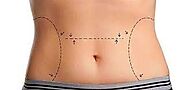 Unlocking Confidence: The Ultimate Guide to Liposuction in Dubai"