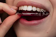 Hawley Retainer: Preserving Your Perfect Smile 