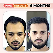 Best Hair Transplant in Karachi Pakistan - 100% Guaranteed - FUE Surgery