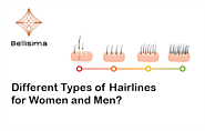 Different Types of Hairlines for Women and Men
