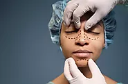 Rhinoplasty: What to Expect Before and After a ‘Nose Job’