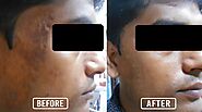 Scar Removal Treatment in Durgapur