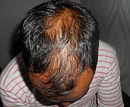 Alopecia Areata Treatment in Durgapur