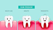 Gum Disease