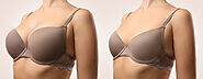 What Is The Difference Between Breast Augmentation And Implants?