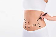 Who is Best Suited for Liposuction?