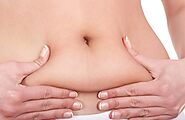 Does Liposuction Remove Fat Forever?