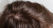 How to cure dandruff permanently: 4 Tips & Tricks