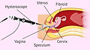 Is Hysteroscopy Essential Before IVF