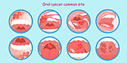 Oral Cancer