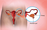 Ovarian Cysts Treatment