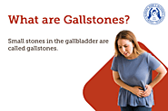 Gallstones And Gallbladder Treatment